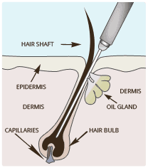 Furless Permanent electrolysis hair removal types of electrolysis